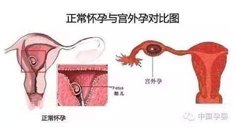 宫外孕前兆是什么样的如何预防宫外孕