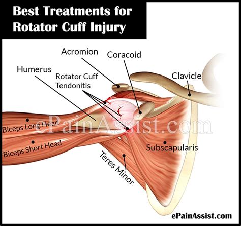 How To Heal A Strained Rotator Cuff Naturally Wiki Hows