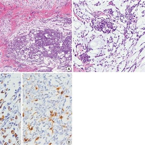 Gross Findings The Tumor Is Well Circumscribed Yellow Gray Soft And