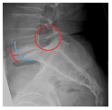 Pars Defect London Neurosurgery Spine And Neurosurgery