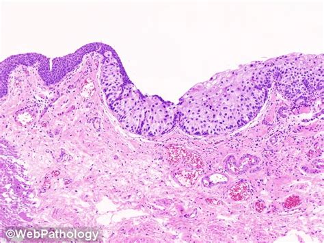 Urothelial Carcinoma In Situ Pagetoid Spread