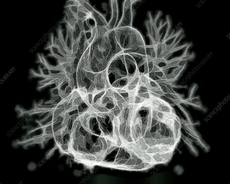 Healthy Heart Ct Scan Stock Image C057 3571 Science Photo Library