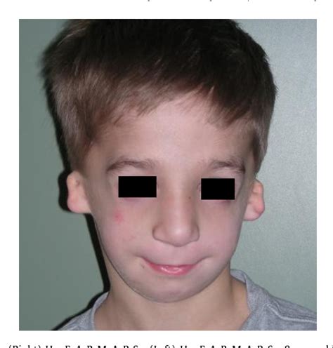 Figure From Hear Maps A Classification For Congenital Microtia