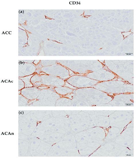 Immunochemistry Staining Of An Adrenocortical Carcinoma Acc A Download Scientific Diagram