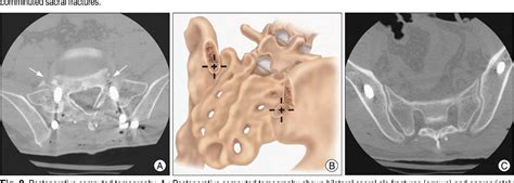 Figure 2 From Lumbo Sacro Pelvic Fixation Using Iliac Screws For The