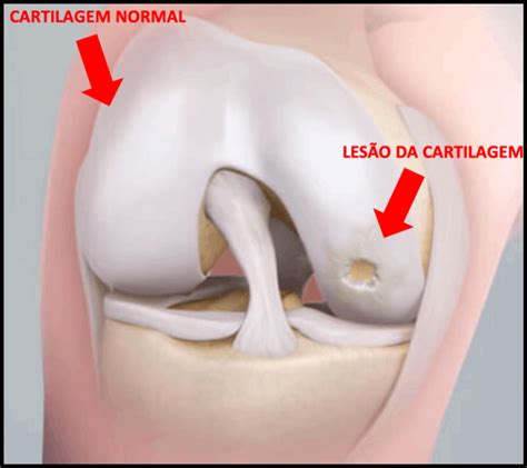 Desgaste Do Joelho Porque Ele Ocorre Diagn Stico E Tratamento