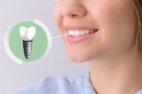 How To Care For Your Dental Implants Roman Dental