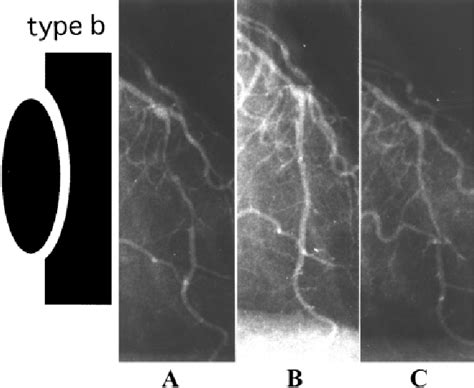 Figure 3 From Angiographic Classification Of Coronary Dissections After