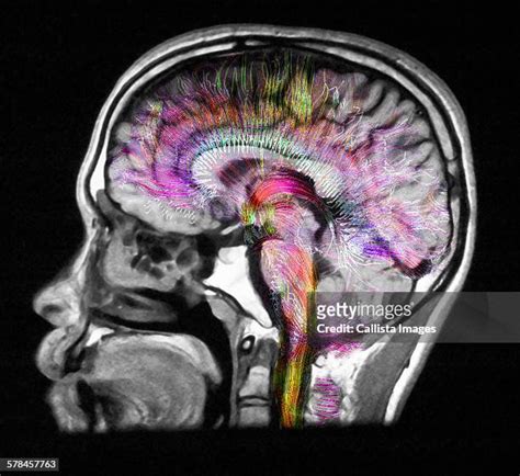diffusion mri stock  high res pictures  images getty