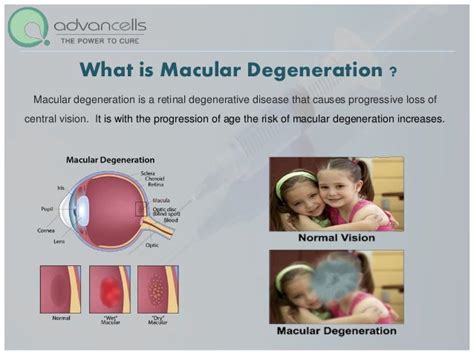 Macular degeneration Treatment | Stem cell Treatment for Macular Dege…