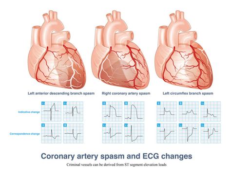 Coronary Artery Disease Free Stock Photos Images And Pictures Of