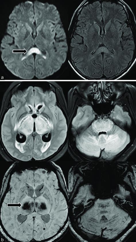 A Dwi And Flair Axial Images Of A Patient Showing Dwi Restriction And