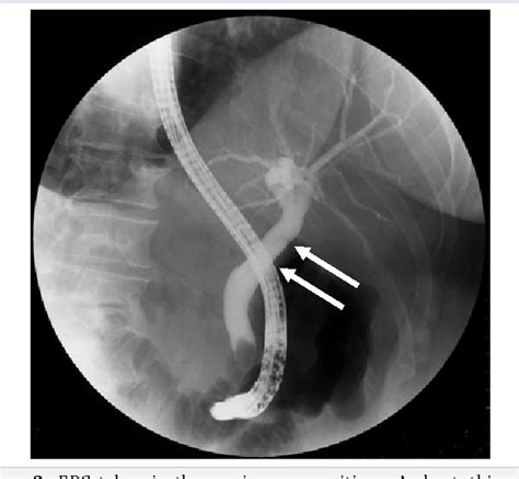 Figure 1 From Congenital Agenesis Of The Gallbladder With The