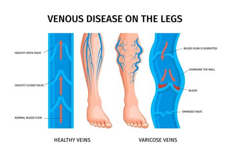 What Is Chronic Venous Insufficiency Nexgen Orthopedic Health And Wellness