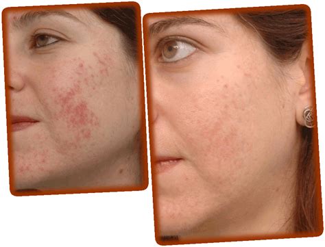 Effective Acne Scar Removal | Impressions MediSpa