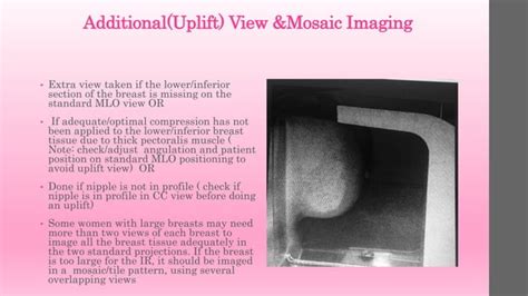 Mammography positioning technique for MLO View | PPT