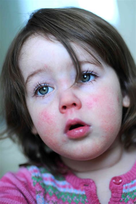 German Measles Pictures Early Stages