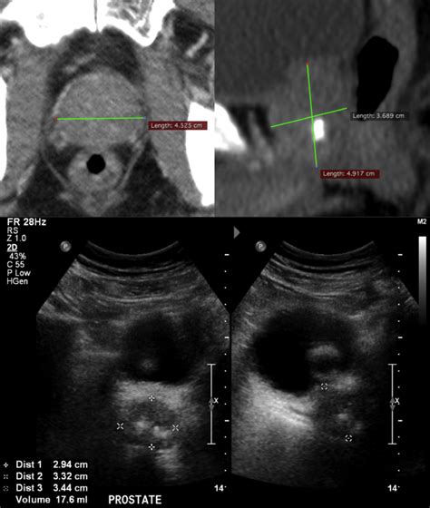 Ct V Taus Comparison Imaging Of Prostate Volume Measurements Using Ct Download Scientific