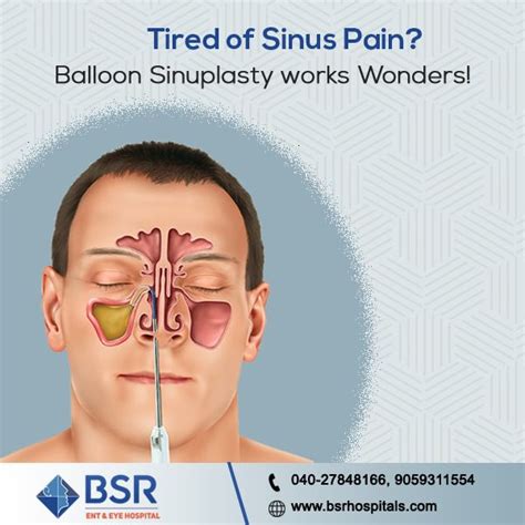 Balloon Sinuplasty Surgery Is Clinically Proven To Provide Excellent