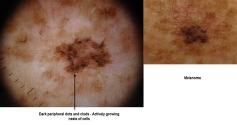 Dermoscopy Made Simple Clues To Melanoma