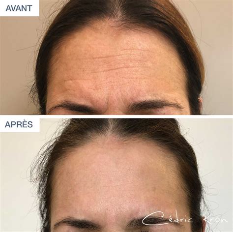 Supprimer Les Rides Du Front Avec Des Injections De Botox