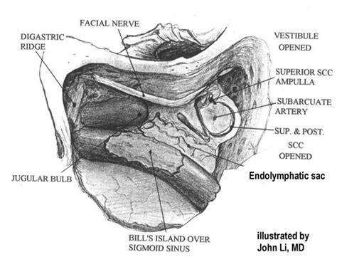 Intraoperative View Of Left Ear Treated With Labyrinthectomy Endolymphatic Sac Can Be Seen In