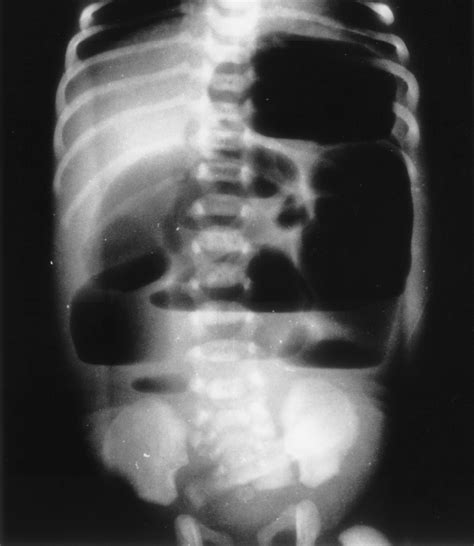 Congenital Anomalies Of The Small Intestine Colon And Rectum