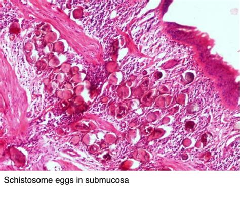 Pathology Outlines Schistosomiasis Bilharziasis