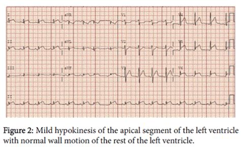 A Rare Case Of Non Rheumatic Streptococcal Acute Myocarditis