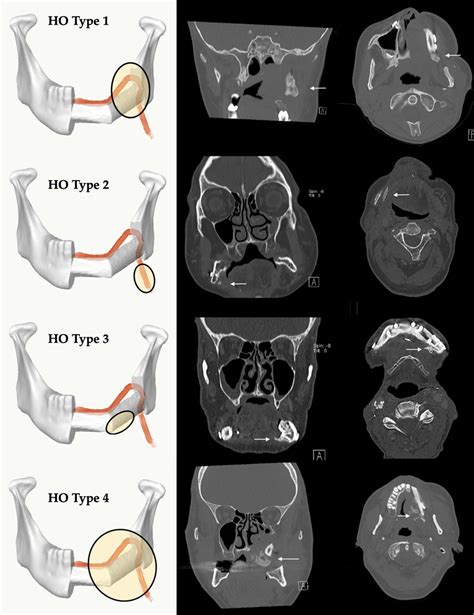 Classification Of Different Radiological Types Of Heterotopic Download Scientific Diagram