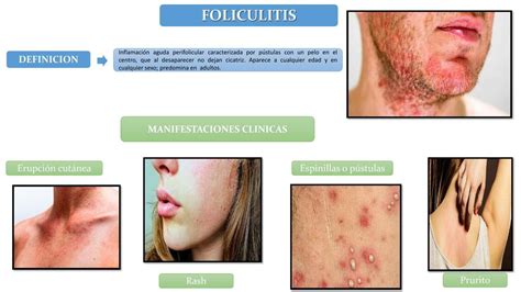 FOLICULITIS JERSON FLORES XD UDocz