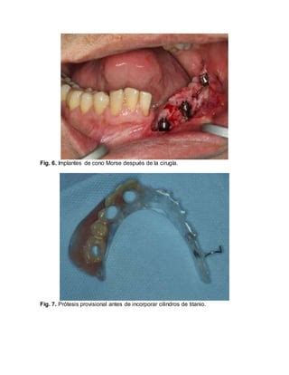 PROTESIS SOBRE IMPLANTES CON CARGA INMEDIATA DESPUES DE RECONSTRUCCION