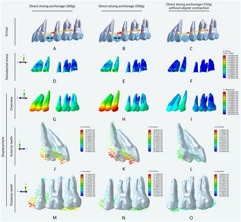 Finite Element Analysis Of The Biomechanical Effect Of Clear Aligners