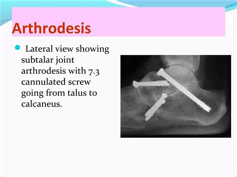 arthrodesis