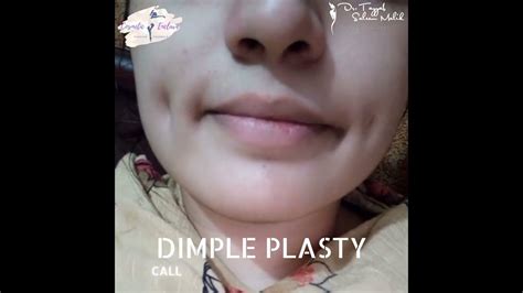 Dimple Surgery. Dimpleplasty - YouTube