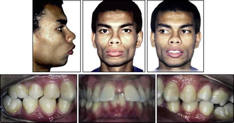 Is Traditional Treatment A Good Option For An Adult With A Class Ii Deepbite Malocclusion