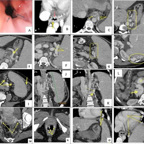 CT abdomen/pelvis showing pelvic varices extending into the wall of ...