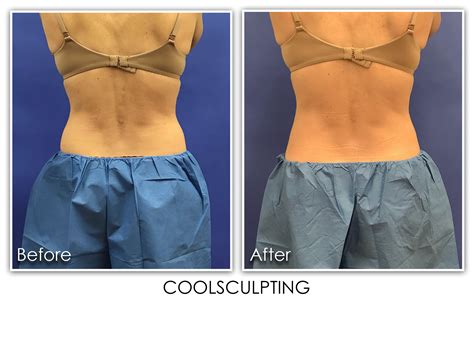 Coolsculpting Pro Archives Skin Rejuvenation Clinic Skin Rejuvenation