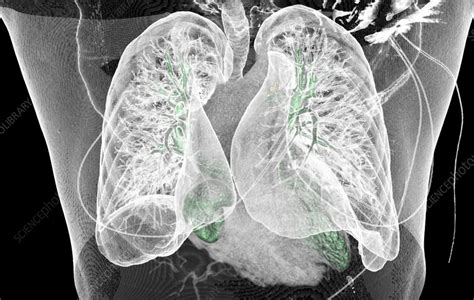 Healthy Lungs Ct Scan Stock Image C058 2852 Science Photo Library