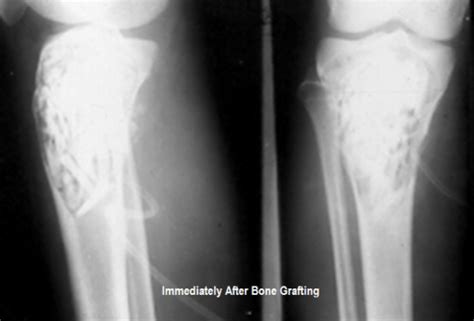 Bone Graft Types and Mechanism | Bone and Spine