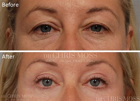 Eyelid Surgery Recovery Photos Eyelid Surgery Cost