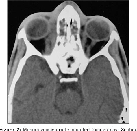 Figure 2 From Analysis Of Computed Tomography Features Of Fungal