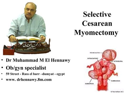 Selective Cesarean Myomectomy Ppt