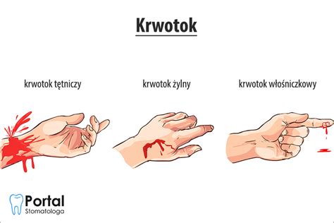 Krwotok Portal Stomatologa