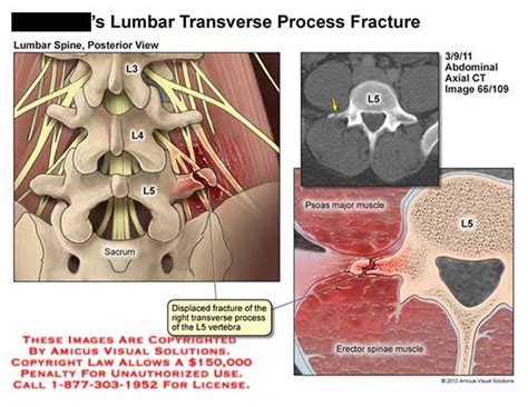 Amicus Illustration Of Amicus Injury Fracture Transverse Process Lumbar L3 L4 L5 Sacrum