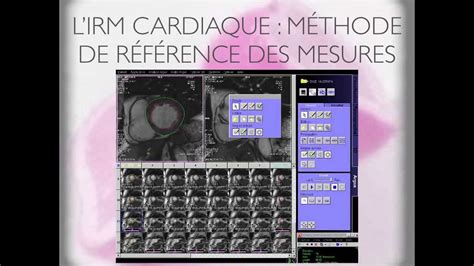 Irm Cardiaque S Quences Et Cas Cliniques N Youtube