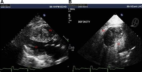 Respect The Septal Perforator Septal Artery Perforation During Cto Pci