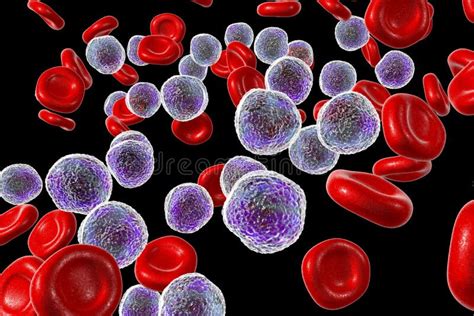 Leucemia Lymphoblastic Aguda Mancha Da Medula Ilustra O Stock