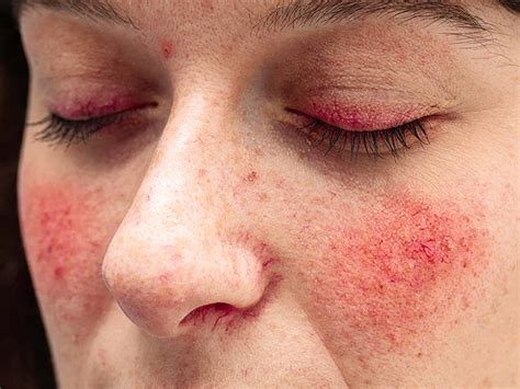 Rosacea Treatments Types Causes And Symptoms