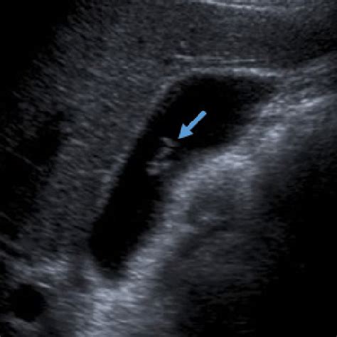 Liver ultrasound-Slight hepatomegaly and diffuse heterogeneous texture ...